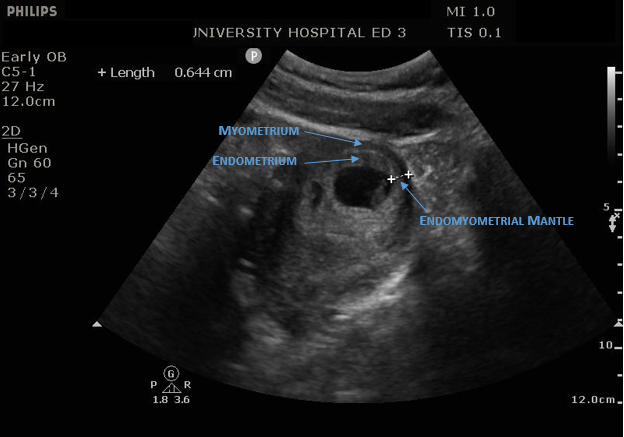 US - Gestational Sacn: Ultrasound of the Month