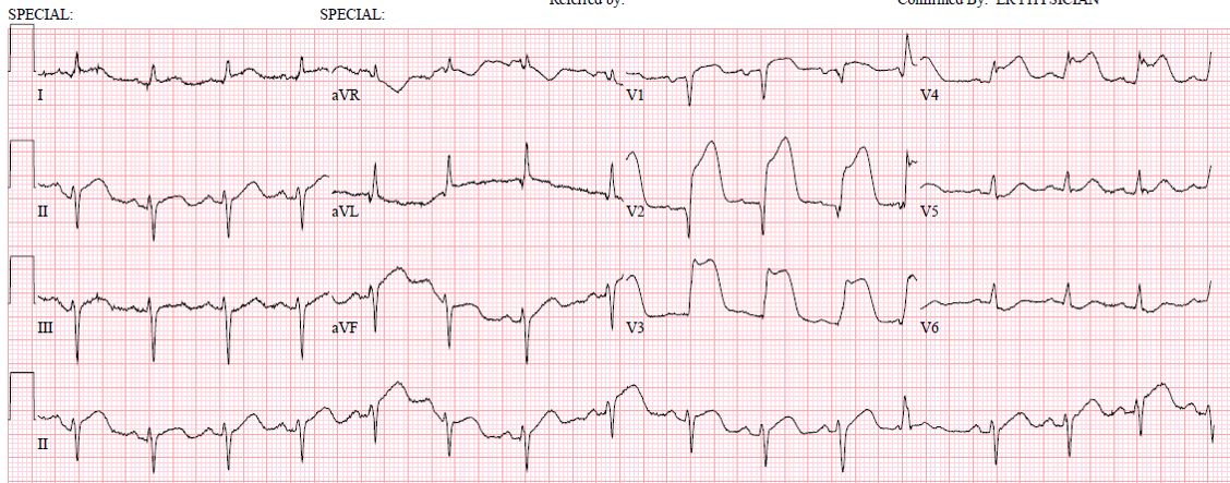 STEMI.png