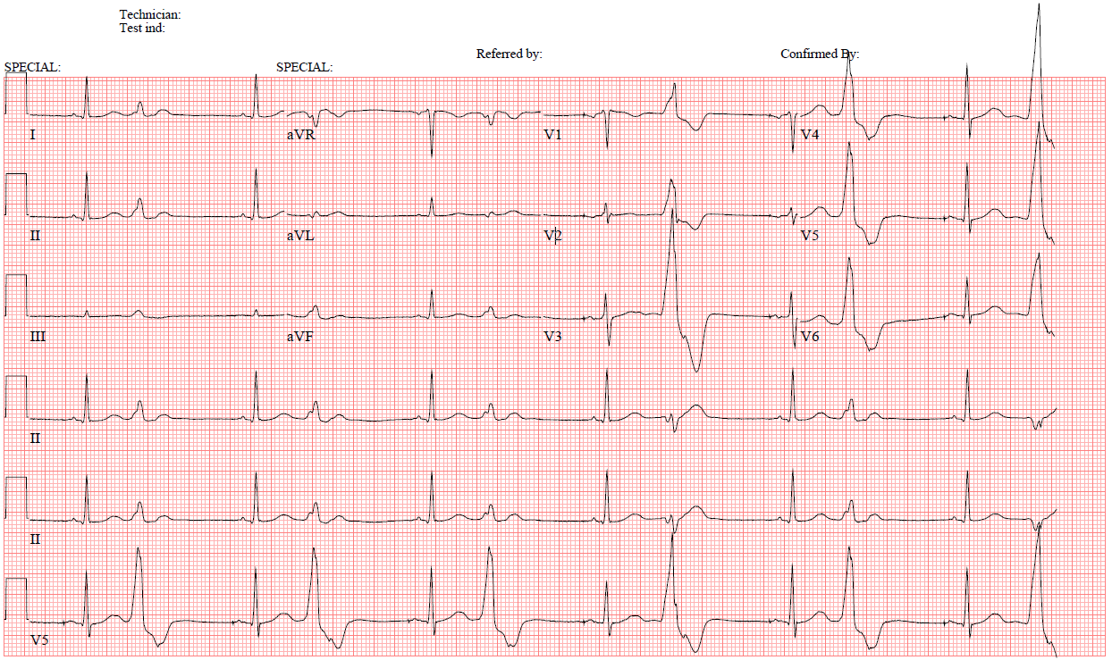 ECG 1.png