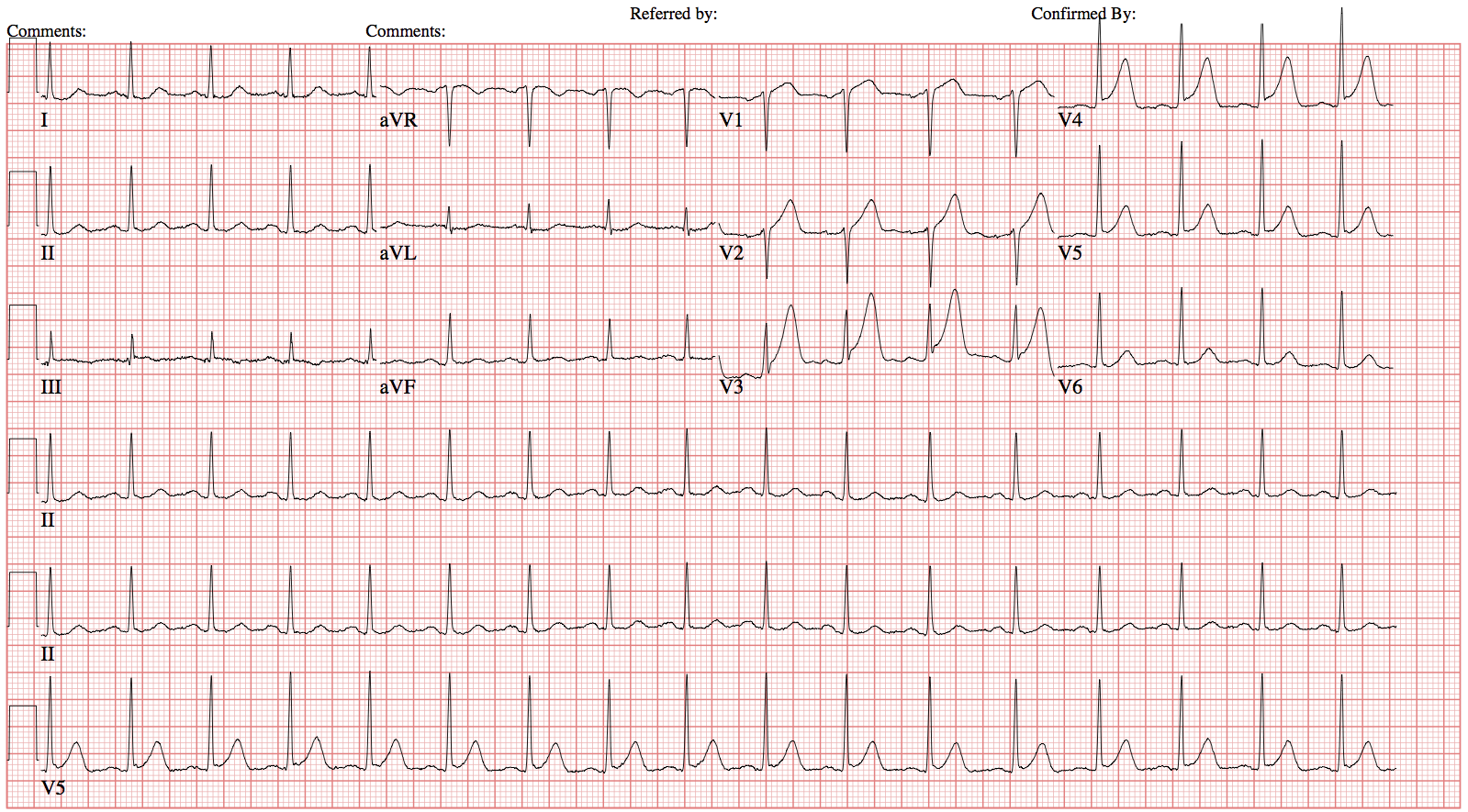 Hyperacute T wave.png