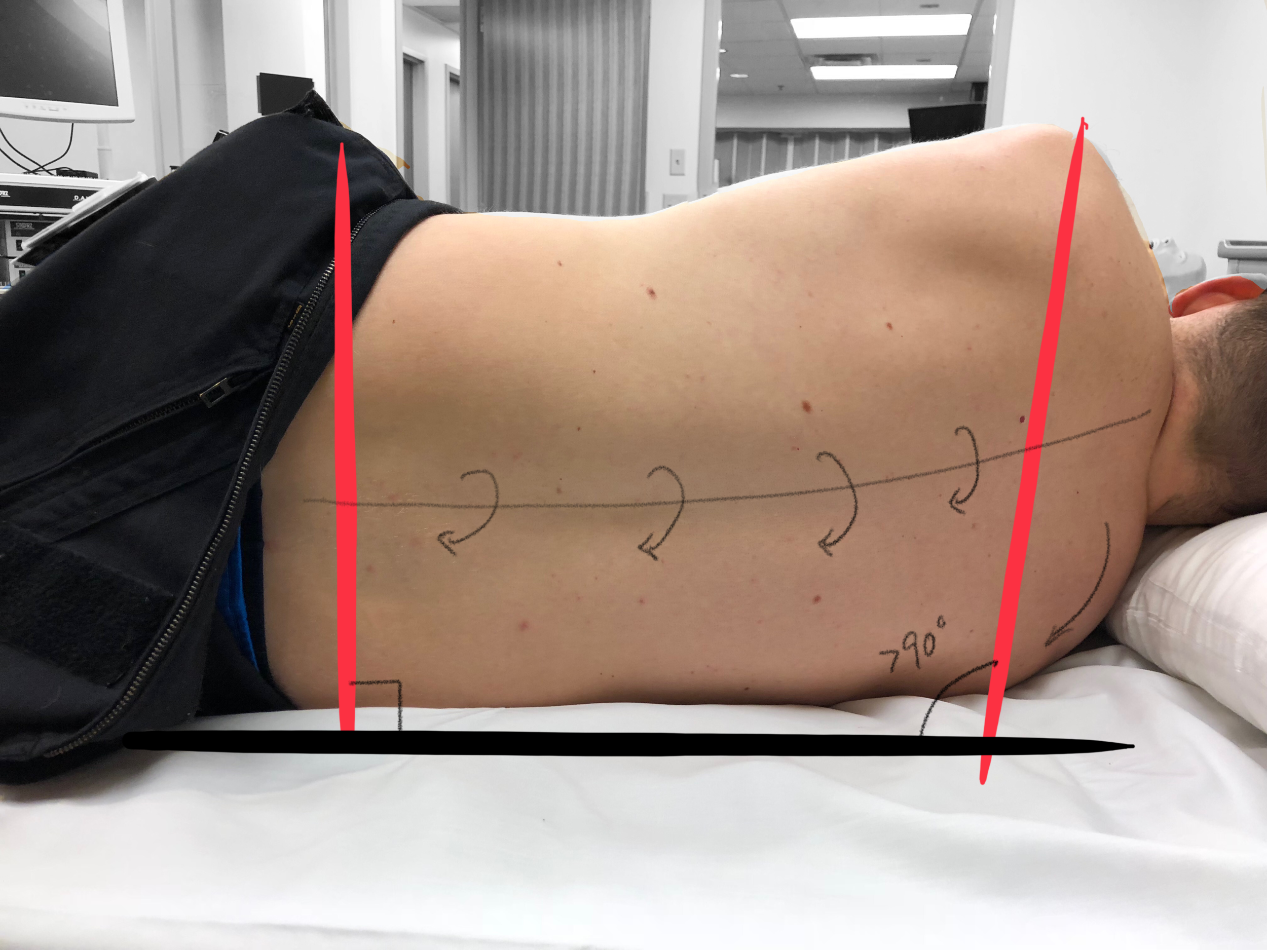 Image 3 - Poor Lateral Decubitus Position - Note that in this case the patients right shoulder is slightly forward introducing a subtle rotation throughout the spinal column, making external landmarks more difficult to appreciate