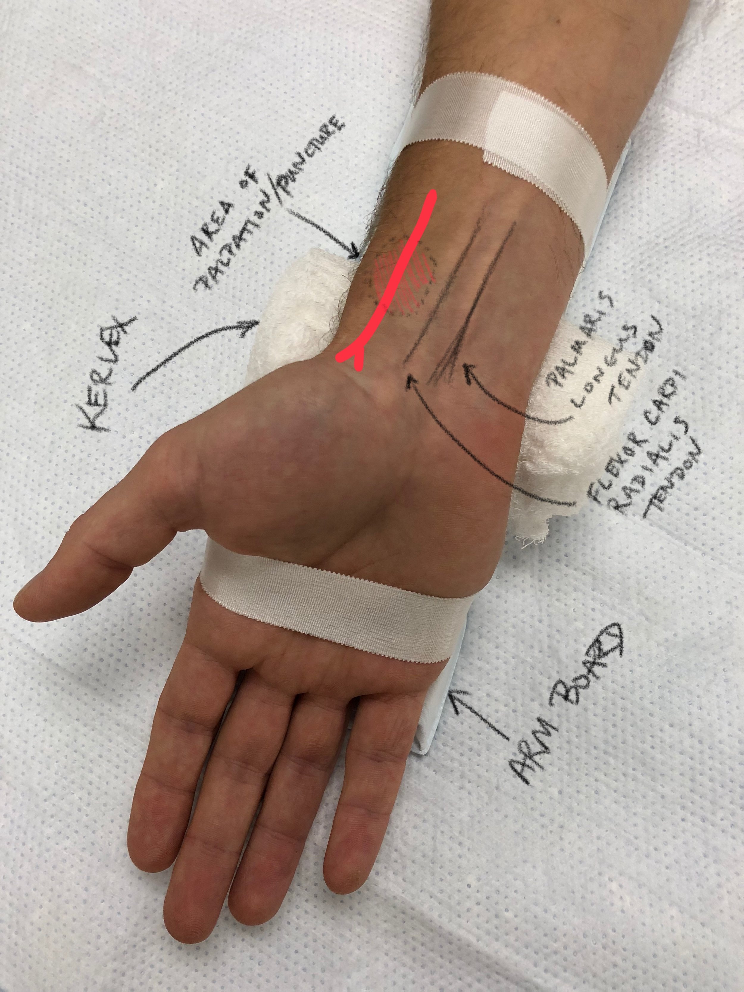 Arterial Line Taming The Sru