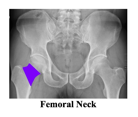XR femoral neck.jpg