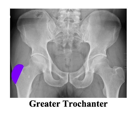 XR greater trochanter.jpg