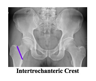 XR intertroch crest.jpg