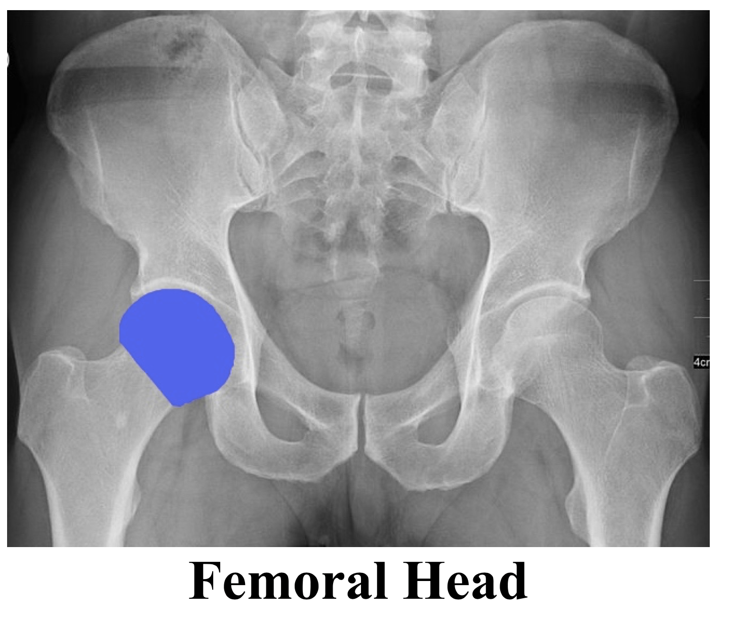 Normal Hip Xray Review Frosdegypt