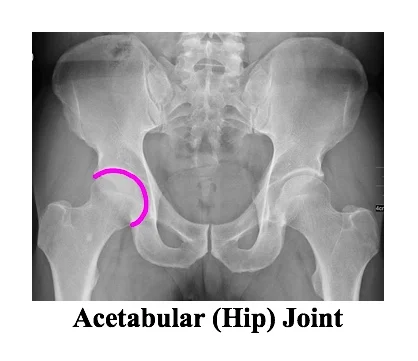 XR hip joint.jpg