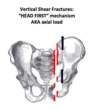 Vertical Shear Fx.jpg