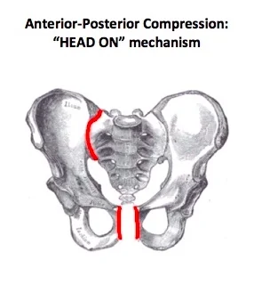 AP Compression Fx.jpg