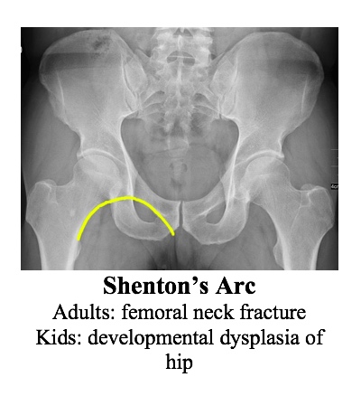 sacrum anatomy xray