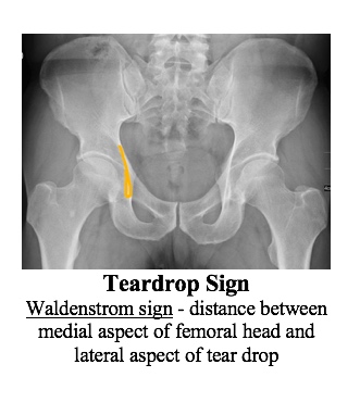 Varicele - Cauze, Simptome, Tratament | Ayurmed