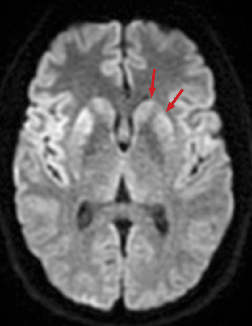 Annals of B-Pod: Creutzfeldt-Jakob Disease — Taming the SRU