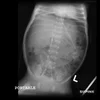 The Abdominal XRay: A relic or a reliable tool? — Taming the SRU