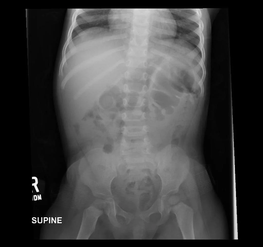 The Abdominal Xray A Relic Or A Reliable Tool Taming The Sru