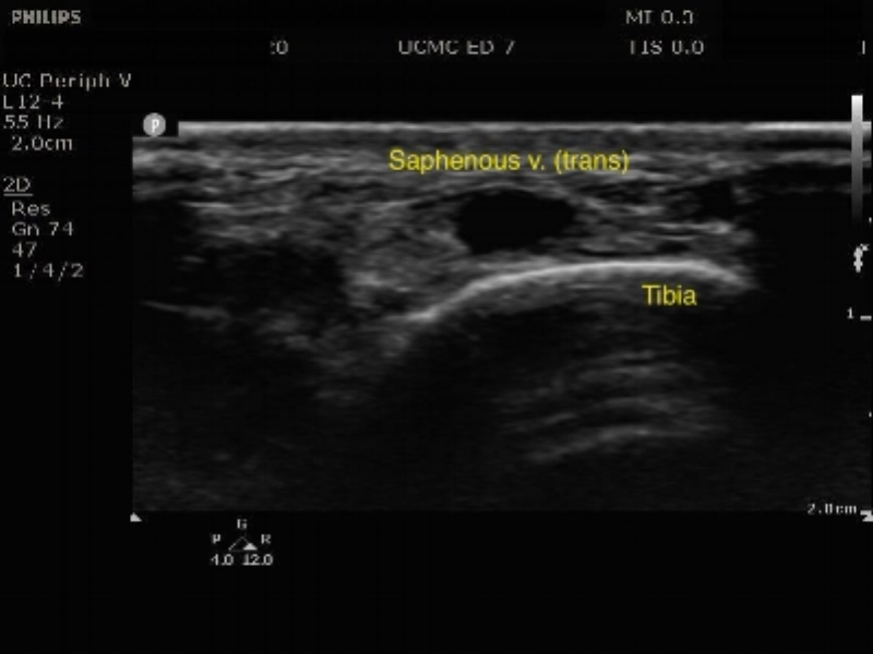 Saphenous vein trans.jpeg