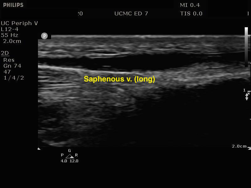 Saphenous vein long.jpeg