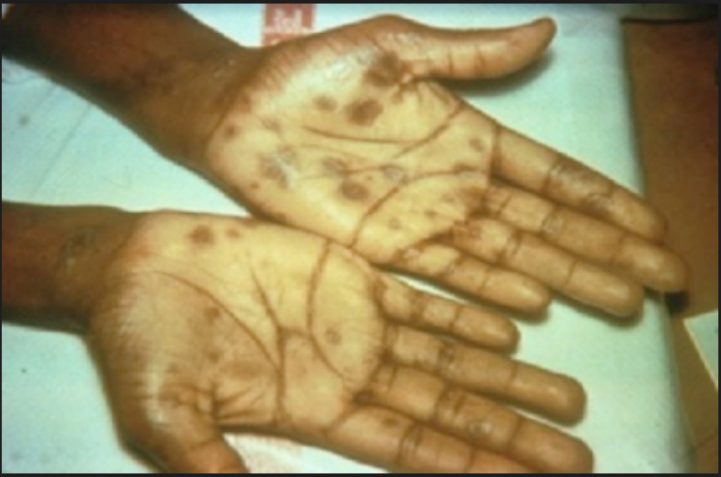 Annals of B-Pod: Neurosyphilis