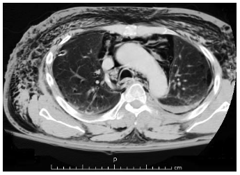Annals of B-Pod: Spontaneous Pneumomediastinum