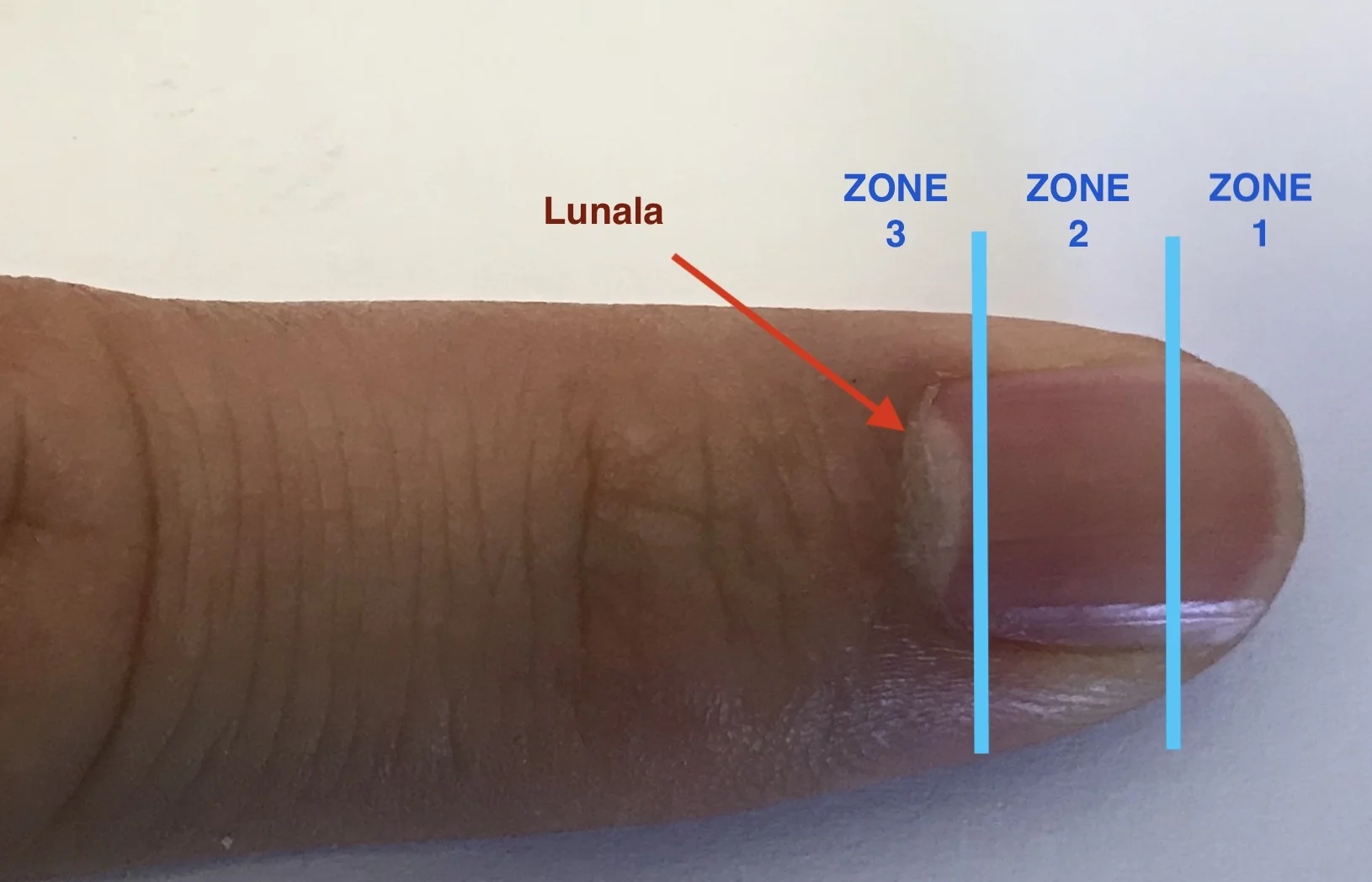 Minor Care Series Fingertip Injuries — Taming the SRU