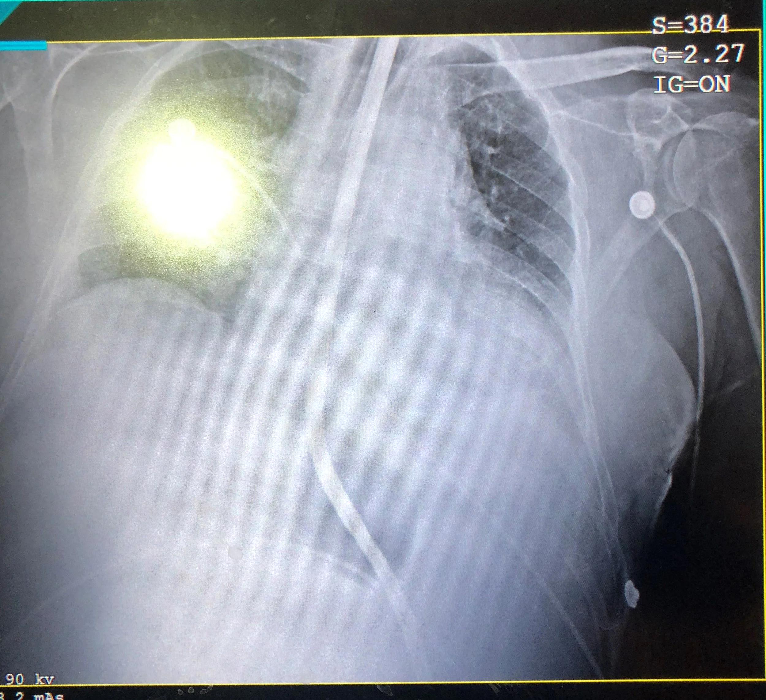 Example 1: This Minnesota tube is in correct position but incorrectly inflated. The gastric balloon is only inflated with 150 cc of air (should have 500 cc), and the esophageal balloon is dangerously overinflated, with a pressure that was undetectably high at > 120 mmHg (normal 30 – 45 mmHg).
