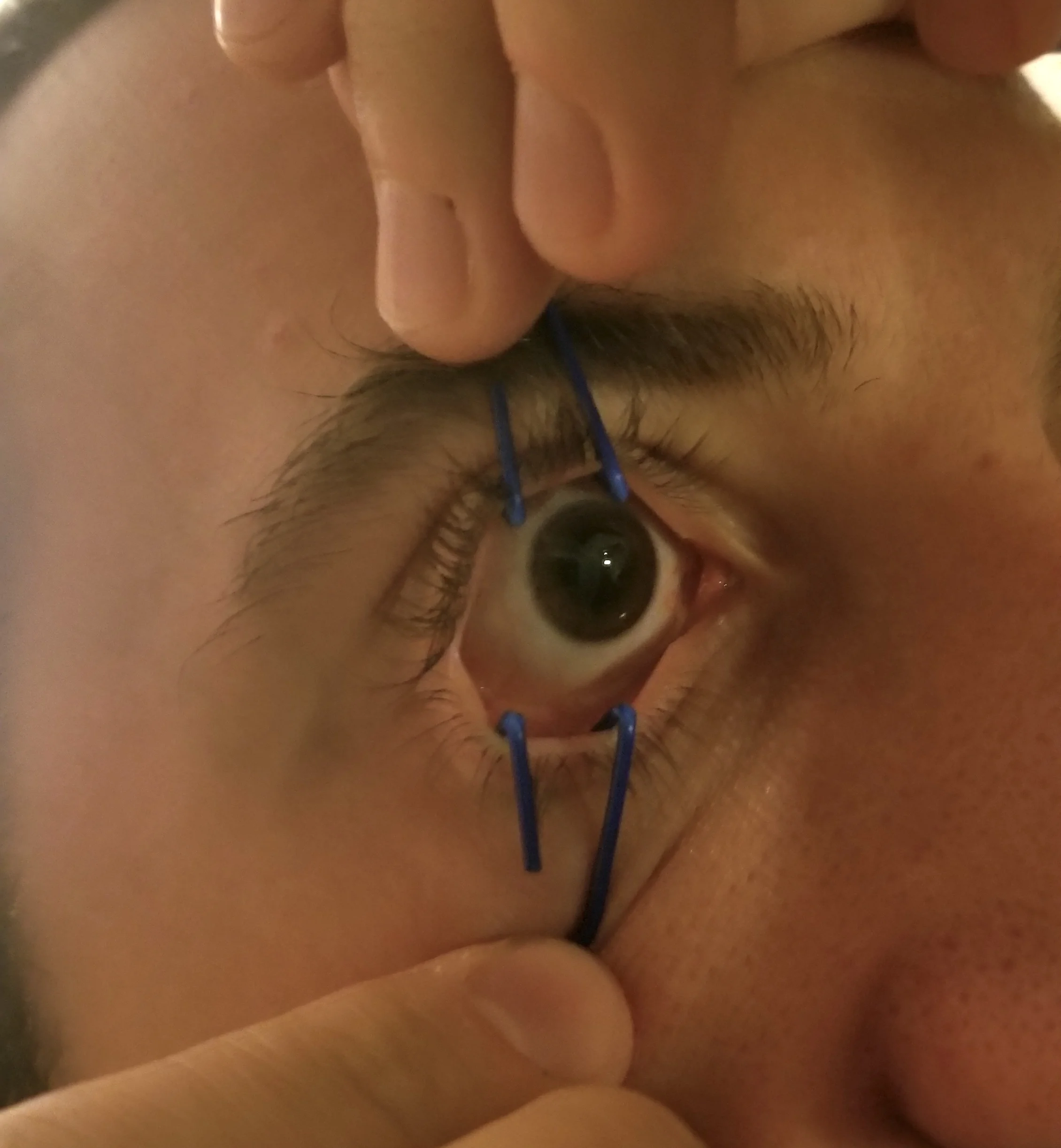 Image 2 - Paperclip Eyelid Retractors in Action Photo courtesy of Michael Spigner, MD, PGY-3 University of Cincinnati Department of Emergency Medicine