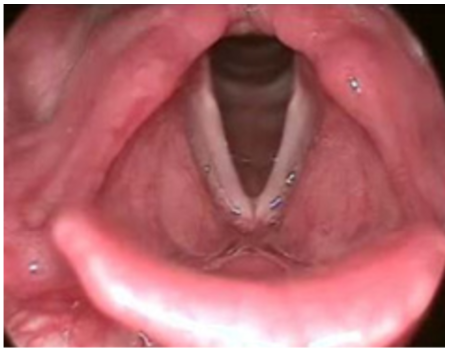 Annals of B-Pod: Hereditary Angioedema