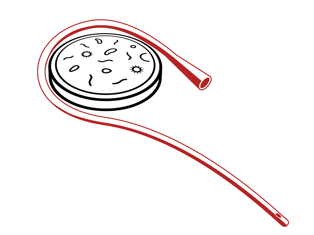 Catheter Associated Urinary Tract Infections and Foley Alternatives