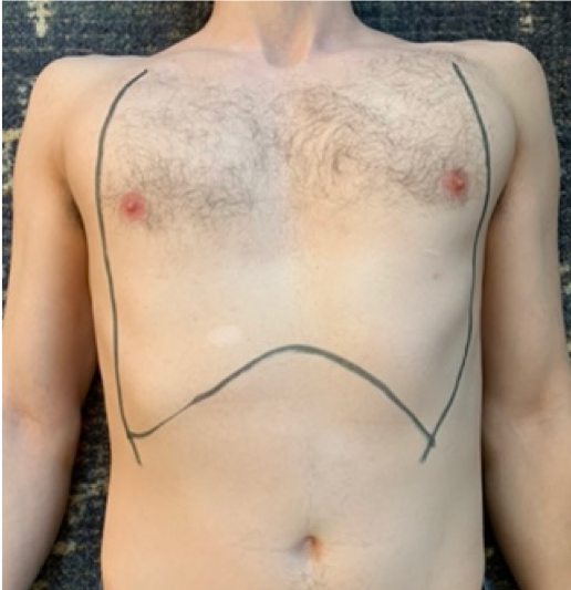 picture 1. Incision sites for chest wall escharotomy