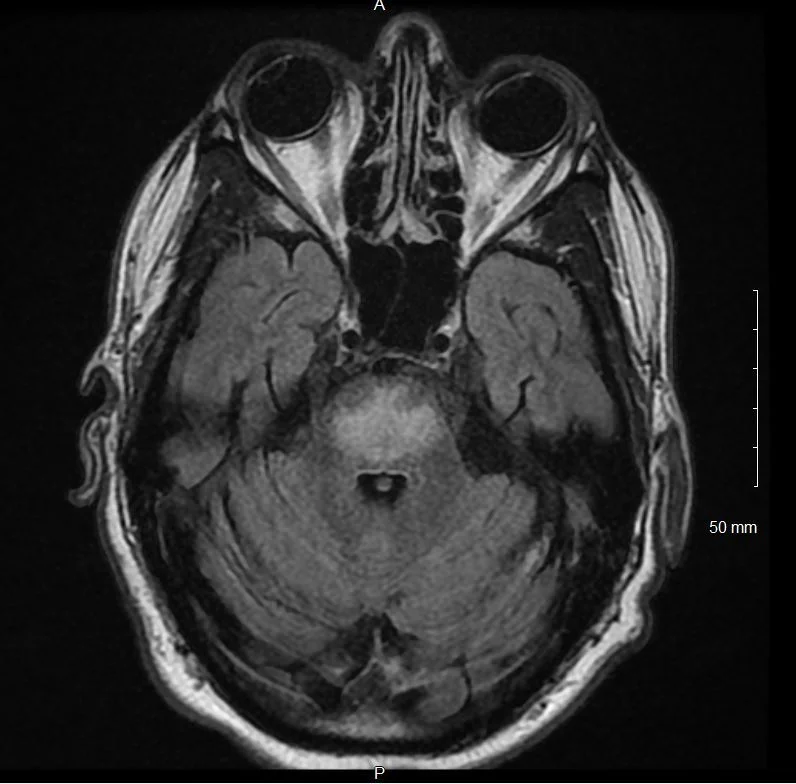 Annals of BPod Osmotic Demyelination Syndrome — Taming the SRU
