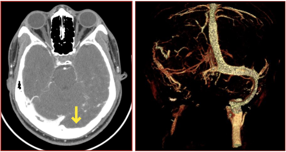 Annals Of B Pod Dural Venous Sinus Thrombosis Taming The Sru