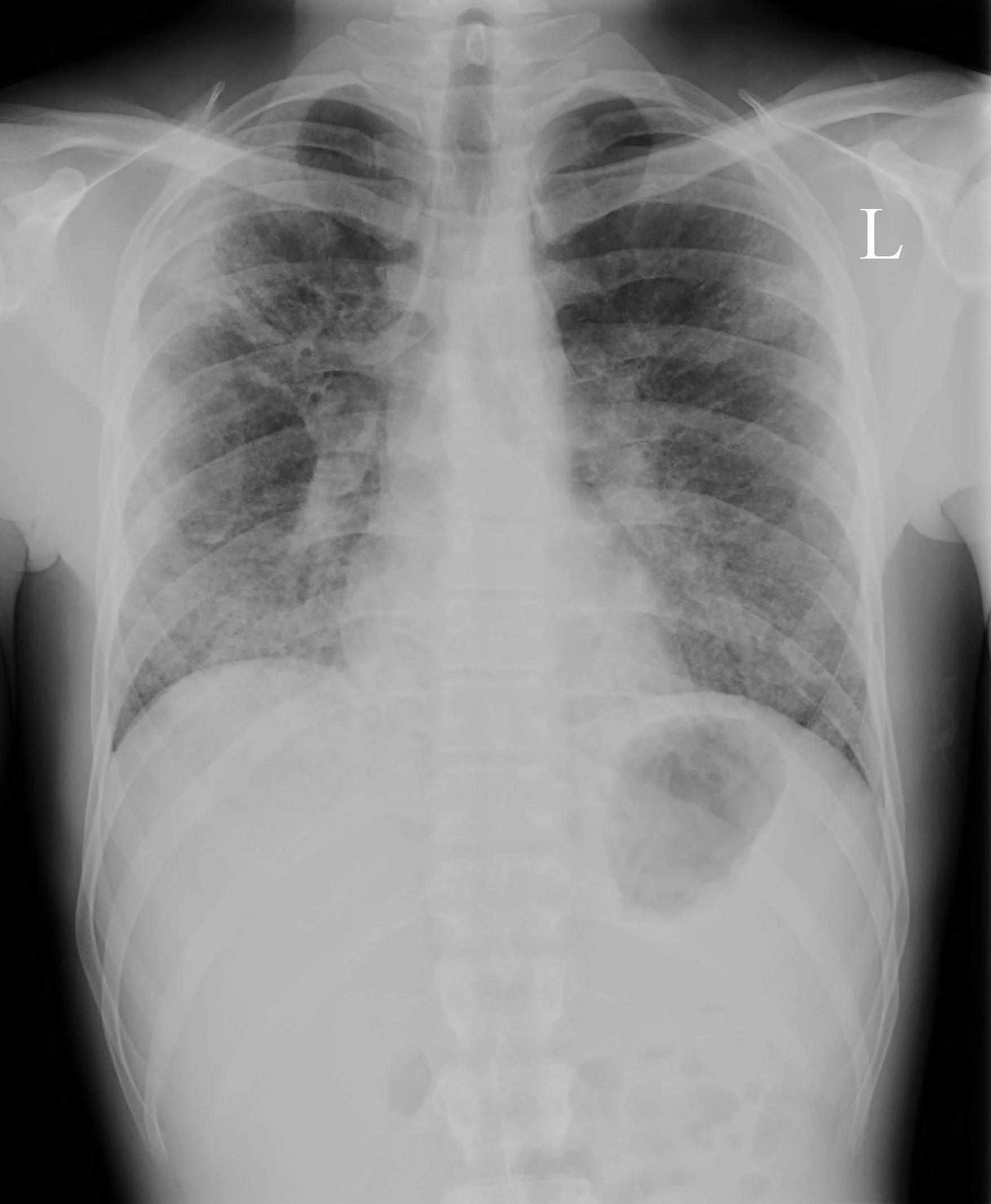 PCP Pneumonia3.jpg