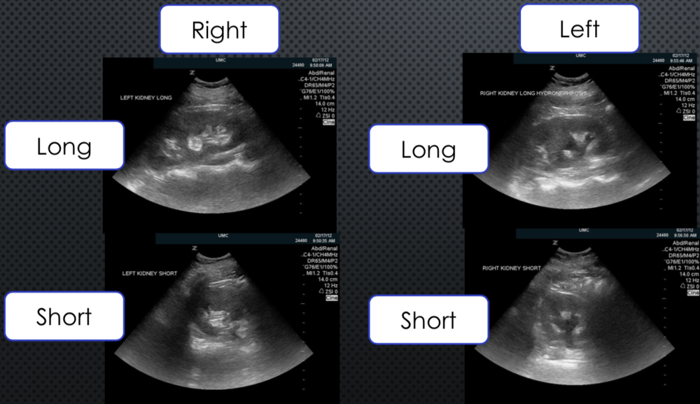 1. Long and Short Axis View of Right and Left Kidney
