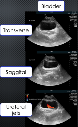 2. Transverse and Saggital View of Bladder with Views of Ureteral Jets