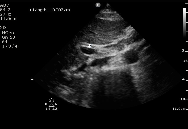 COMMON BILE DUCT MEASUREMENT