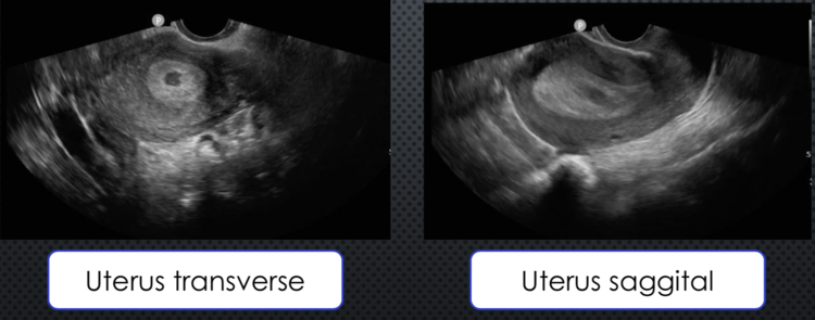 preg transvag.png