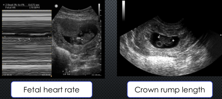 Scanning School - Early Pregnancy — Taming the SRU