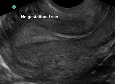 NO GESTATIONAL SAC, NO INTRAUTERINE PREGNANCY