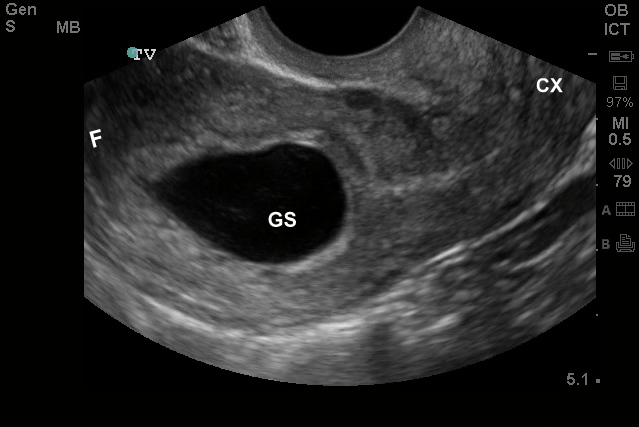 GESTATIONAL SAC BUT NO EVIDENCE OF YOLK SAC OR FETAL POLE = NO IUP