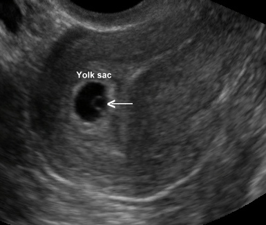 GESTATIONAL SAC + YOLK SAC + SURROUNDED BY MYOMETRIUM* = IUP