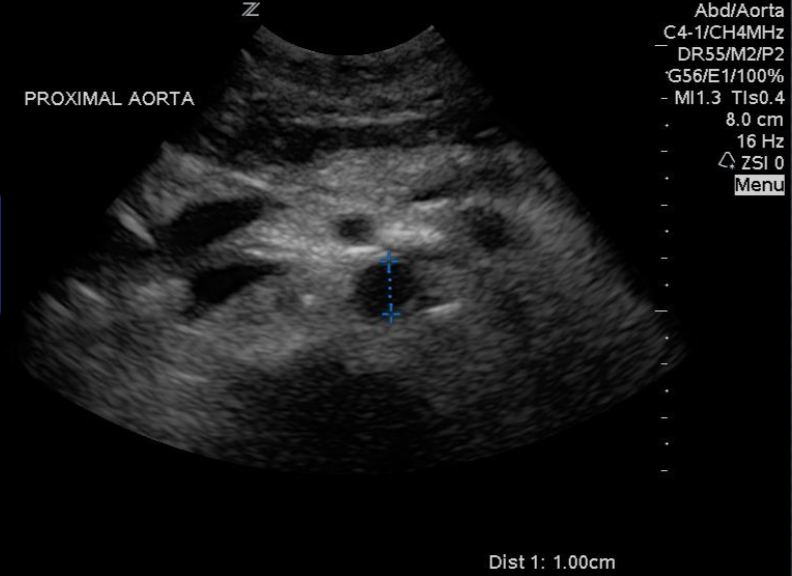 aorta 1 prox.png
