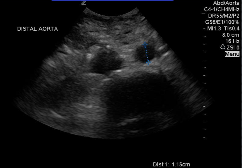 aorta distal.png