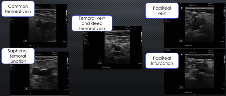 le+dvt.png