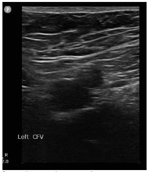 Common femoral vein and artery without Compression