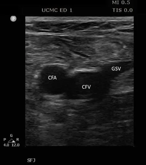 The saphenofemoral junction: CFA = common femoral artery, CFV = common femoral Vein, GSV = great saphenous vein