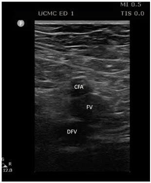 At the level of the femoral vein and deep femoral veins; CFA = common femoral artery, FV = femoral vein, DFV = deep femoral vein
