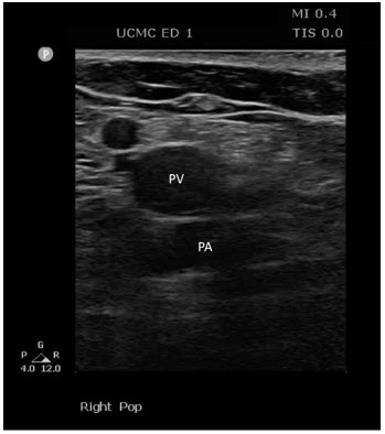 In the popliteal space; PV = popliteal vein, PA = popliteal artery