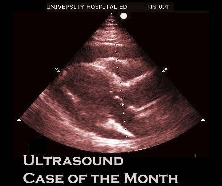Ultrasound of the Month: Lower Uterine Segment Gestation