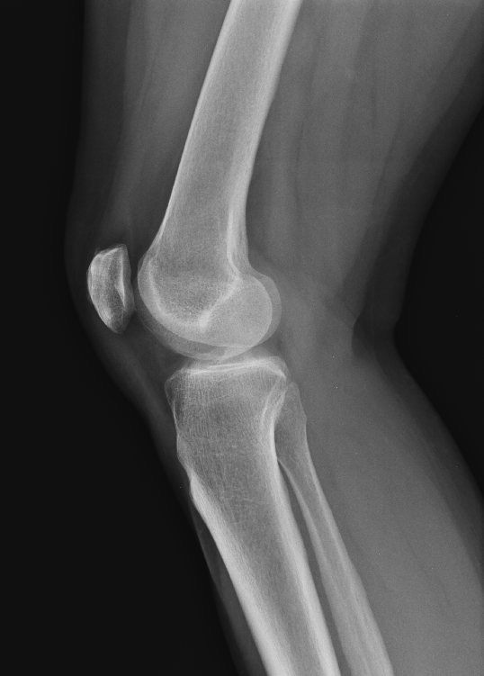 Lateral Knee XR