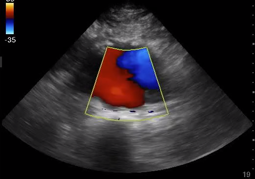 Aortic Aneurysm Ultrasound