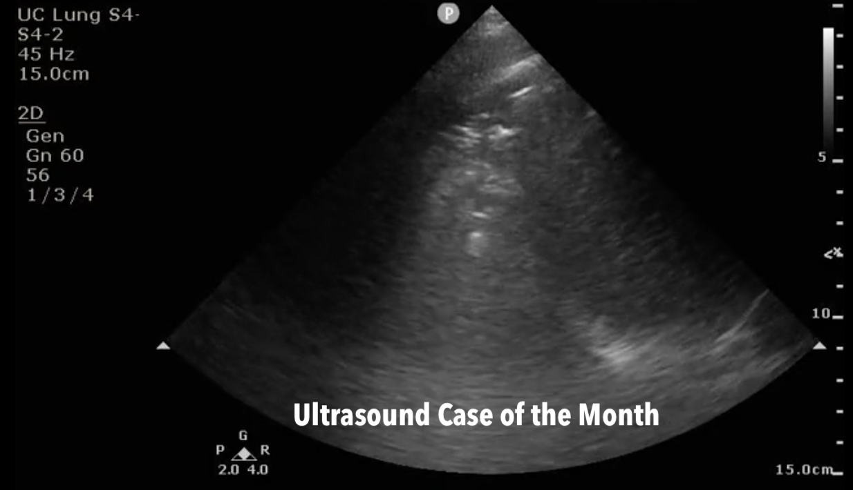 Ultrasound Case of the Month: To B-Line or not to B-Line - Sonographic Diagnosis of Pneumonia